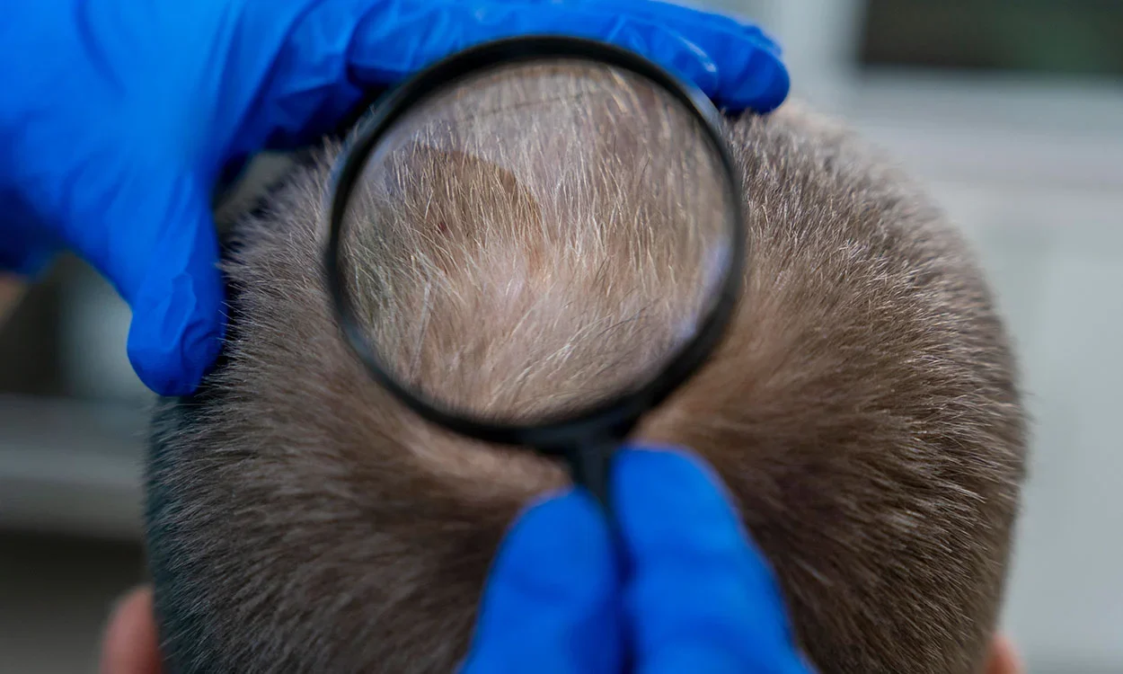 Tratamiento de las alteraciones estructurales del cabello